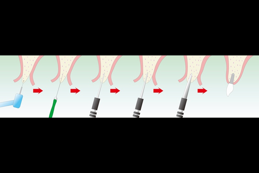 ドリルはほとんど使用せずに骨を拡げてインプラントを埋入
