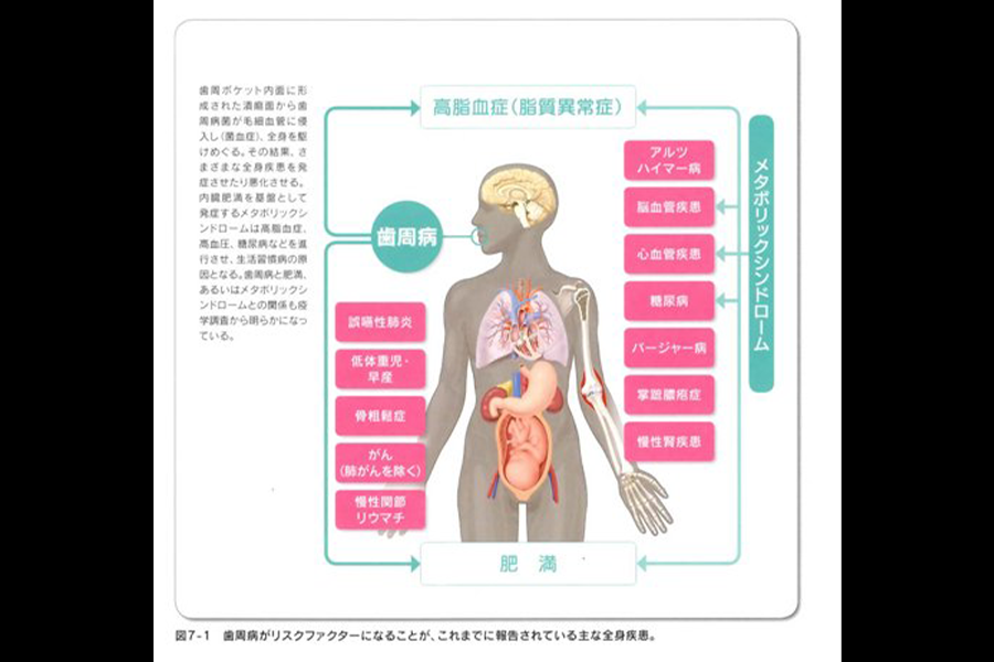 歯周病が全身に及ぼす影響