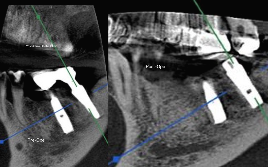 歯周治療・インプラント周囲治療のための Er:YAGレーザー パーフェクトガイ… シエン社 | 歯周治療・インプラント周囲治療のためのEr：YAG
