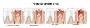 cavity on front tooth